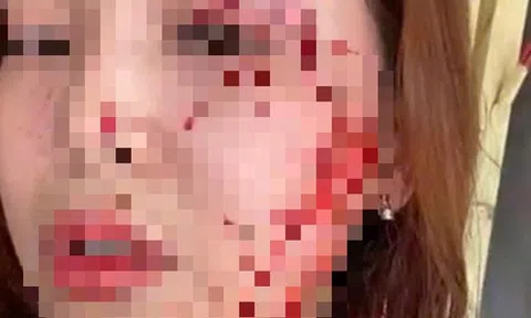 Khởi tố vụ một phụ nữ ở Nha Trang "bị người không quen biết rạch mặt"